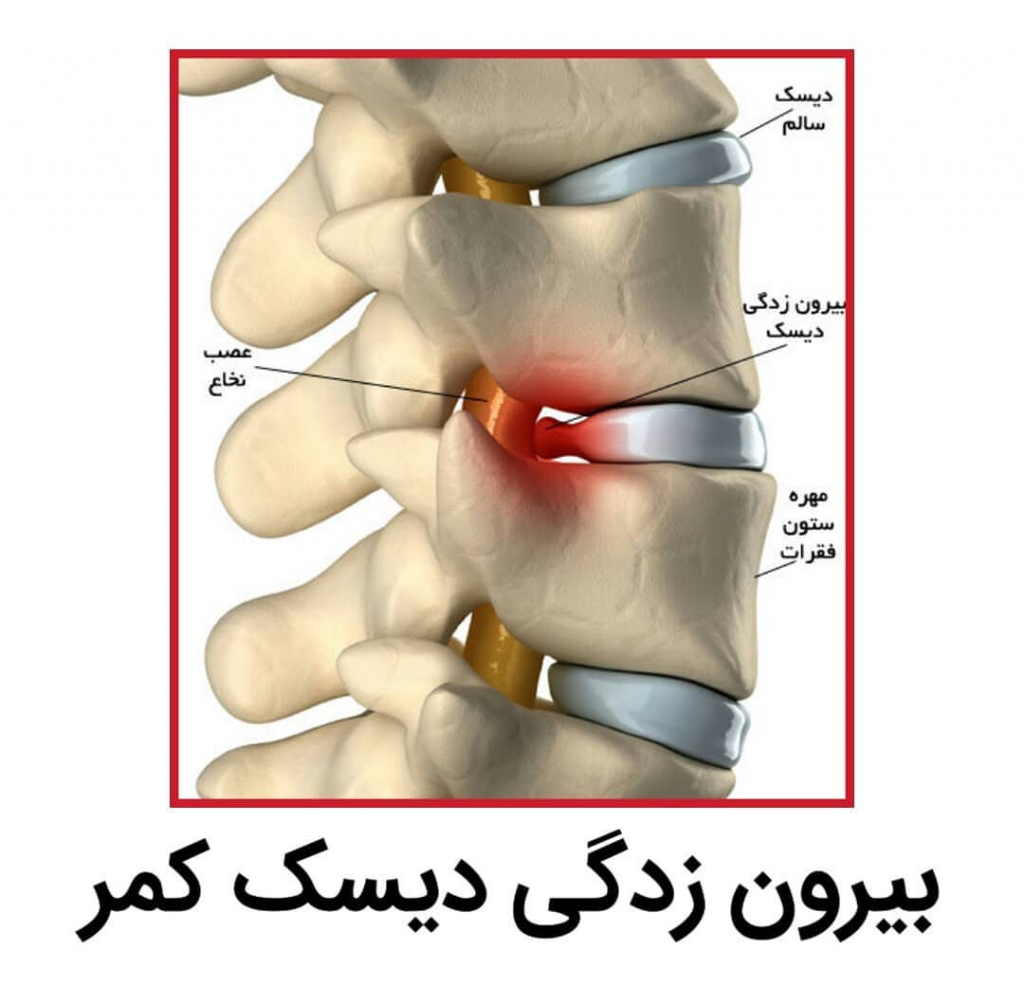 بیرون زدگی دیسک کمر